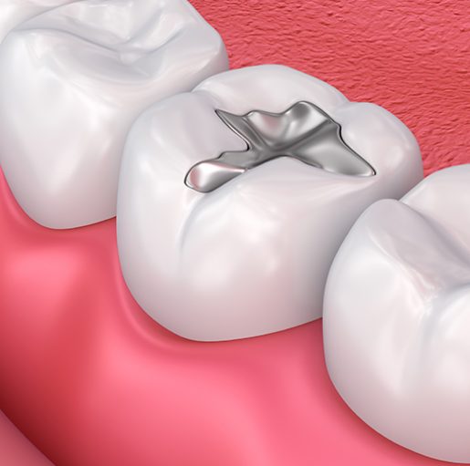 Treatment - Kreate Dental